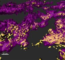 Image shows a rendered confocal laser scanning micrograph of a mixed species bacterial biofilm observed in a chronic wound model of infection. Staphylococcus aureus (yellow) and Pseudomonas aeruginosa (purple), organize themselves in small, dense clusters of cells called aggregates. (Credit: Sophie Darch, Whiteley Lab and Rumbaugh Lab at Texas Tech University Health Sciences Center.)